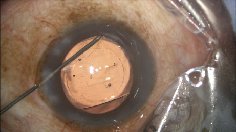 After IOL implantation, while dispersive viscoelastic fills the anterior chamber, a 27-gauge Knolle cannula on a 1 cc tuberculin syringe is inserted behind the iris and above the peripheral anterior capsule.