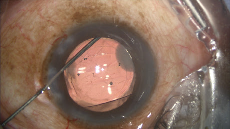 Once the cannula is advanced through the zonules, 0.2 cc of TriMoxiVanc is injected into the retrozonular space of Petit. 
